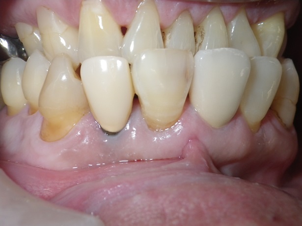 定期検診と虫歯の診断　小窩裂溝齲蝕　根面齲蝕  非活動性齲蝕