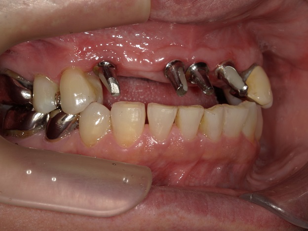 骨格性下顎前突症の上顎前歯インプラント、能代市、北秋田市、大館市