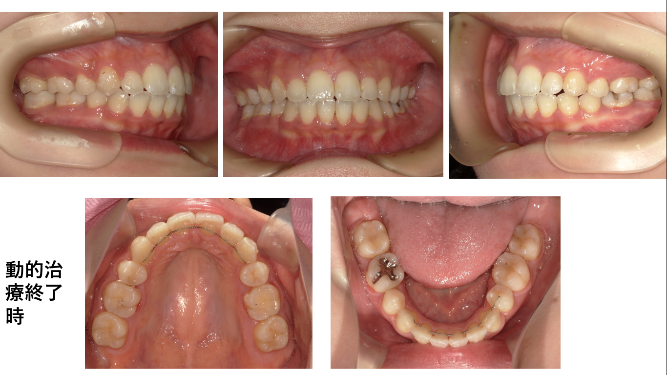 矯正症例113 AngleⅠ級叢生、能代市、北秋田市、大館市、秋田市