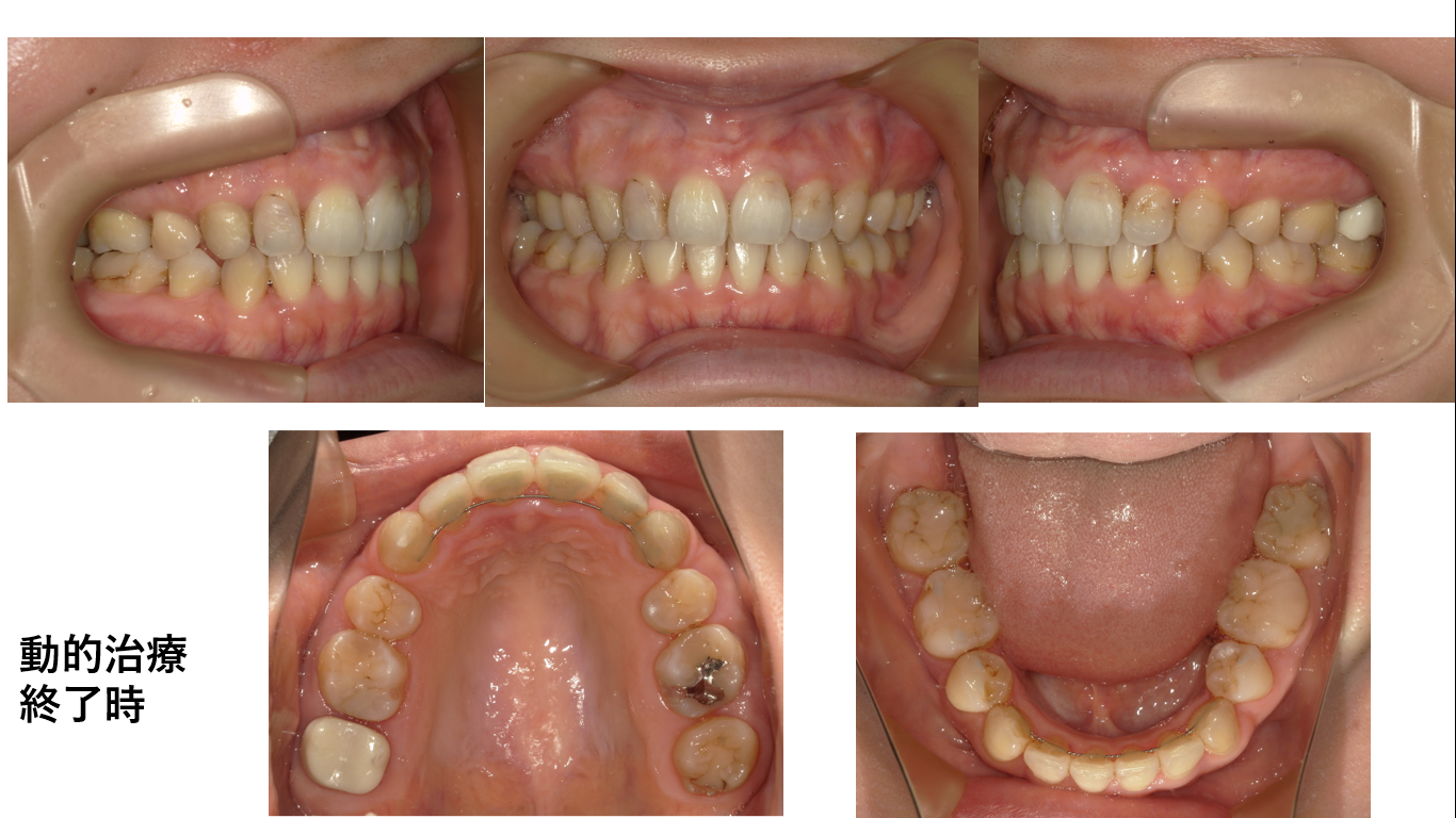 矯正症例118 AngleⅠ級上下顎前突、ハーフリンガル、舌側矯正、裏側矯正、能代市、北秋田市、秋田市、大館市