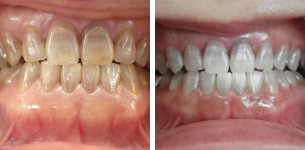 テトラサイクリン変色歯のホワイトニング症例を追加しました。