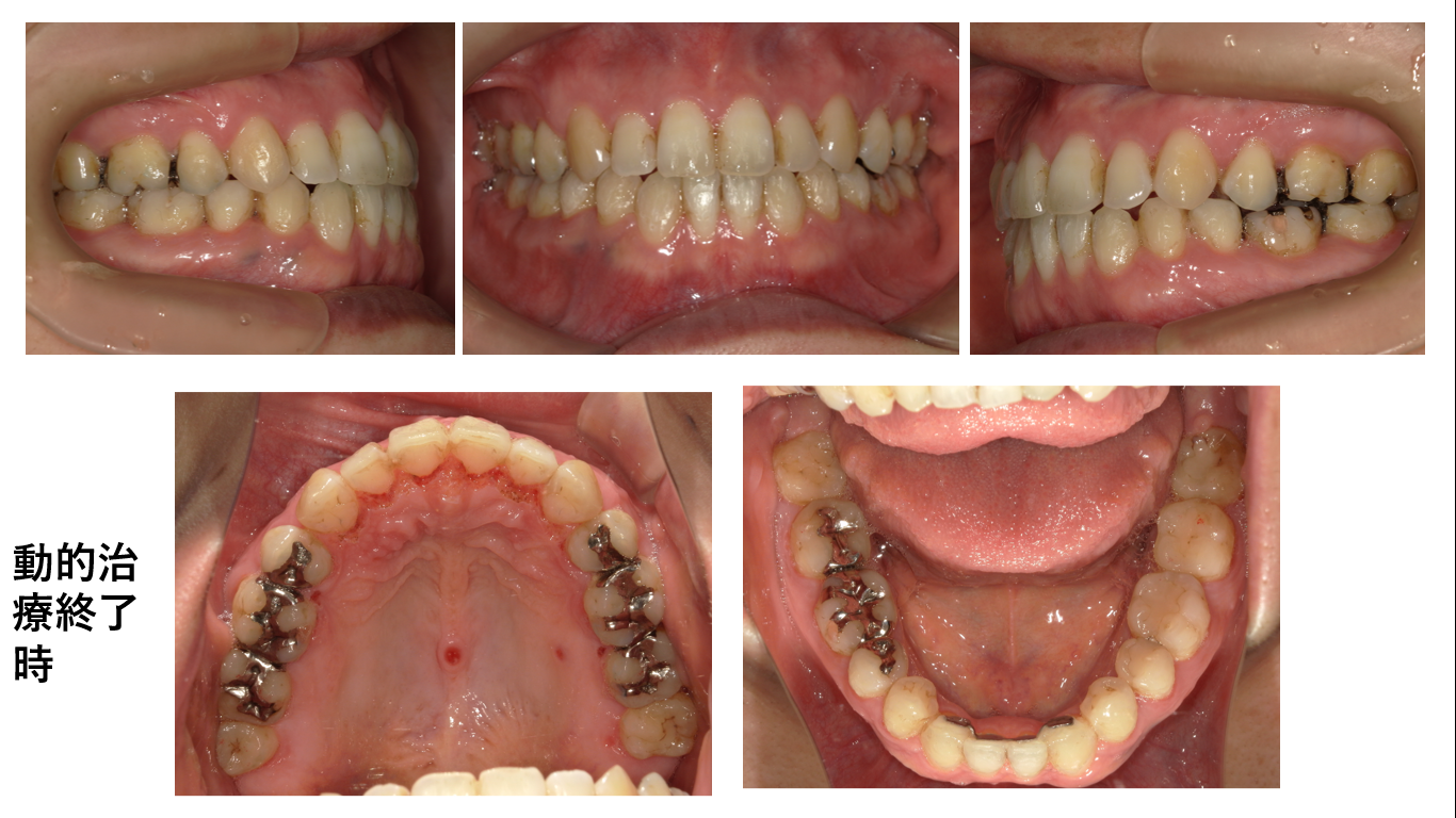 矯正症例120 Skeletal classⅢ叢生、下顎3本切歯症例、ハーフリンガル、舌側矯正、裏側矯正、能代市、大館市、北秋田市、秋田市