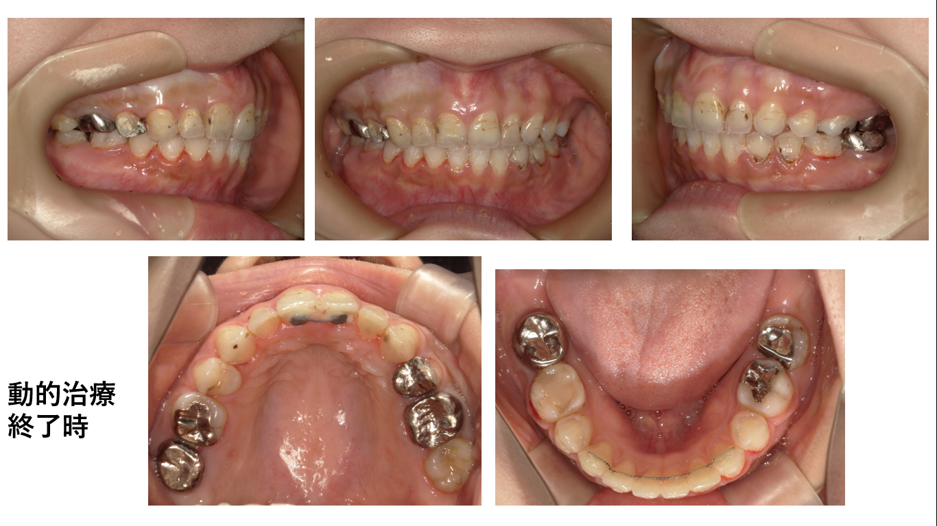 矯正症例112,AngleⅡ級1類、ハーフリンガル症例、舌側矯正、裏側矯正、能代市、北秋田市、秋田市、大館市