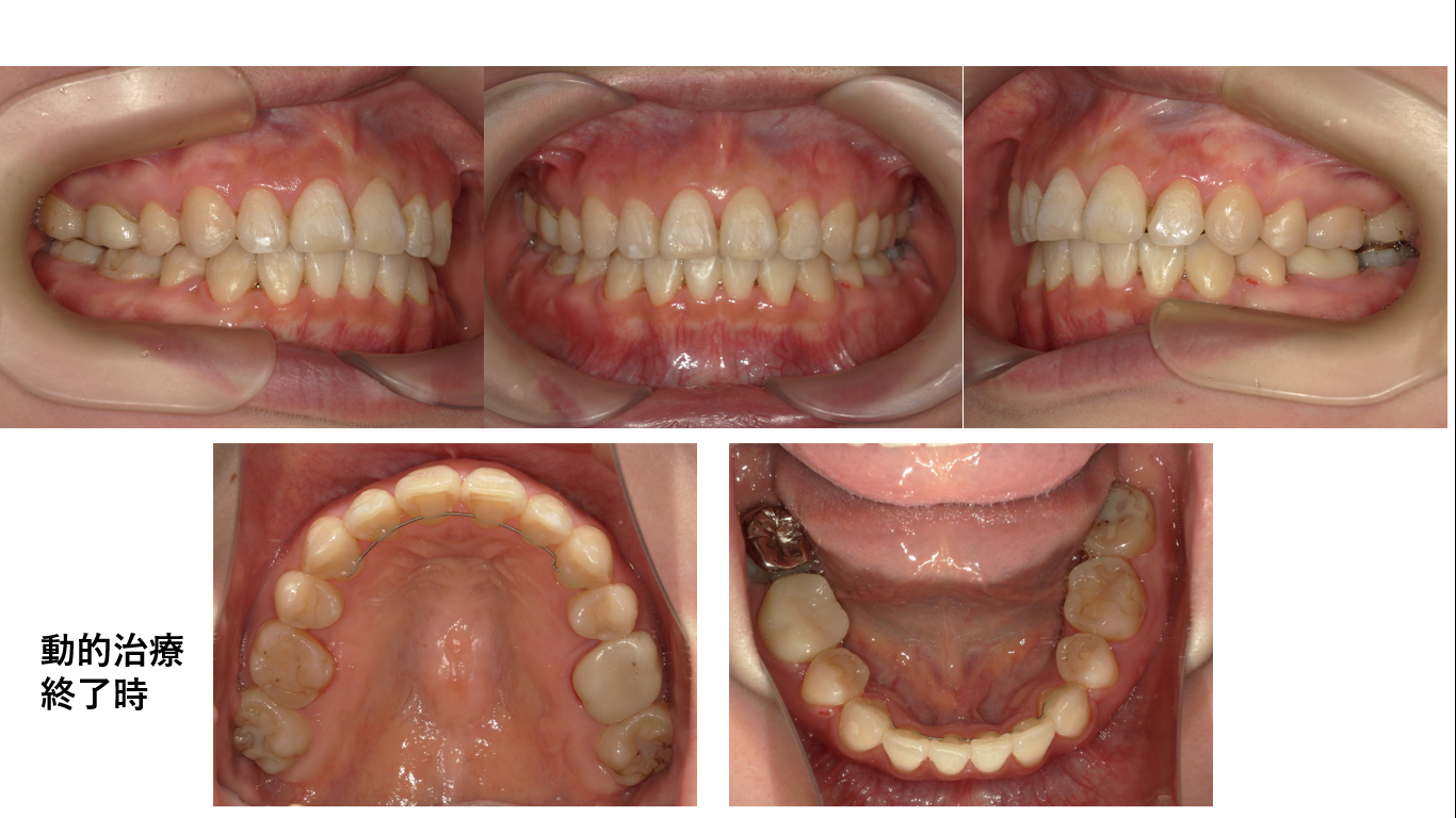 矯正症例116AngleⅡ級叢生、能代市、北秋田市、大館市、秋田市