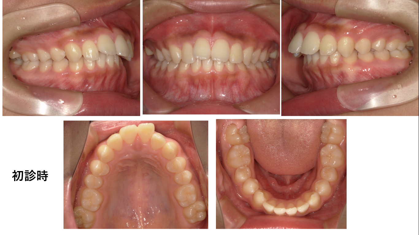 矯正症例122 Angle classⅡ 上顎前突、能代市、北秋田市、秋田市、大館市