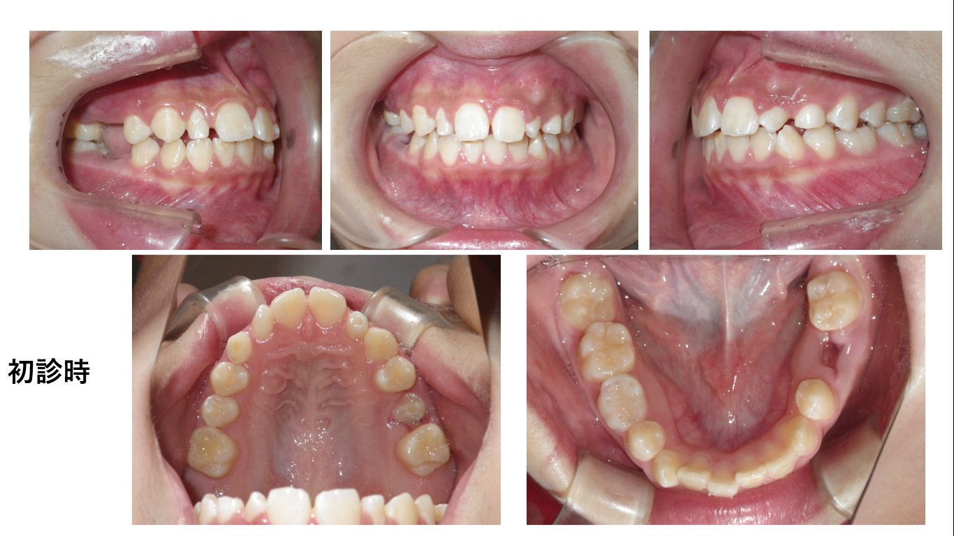 矯正症例115　AngleⅠ級叢生、上顎左右側2番抜歯症例、能代市、大館市、北秋田市、秋田市