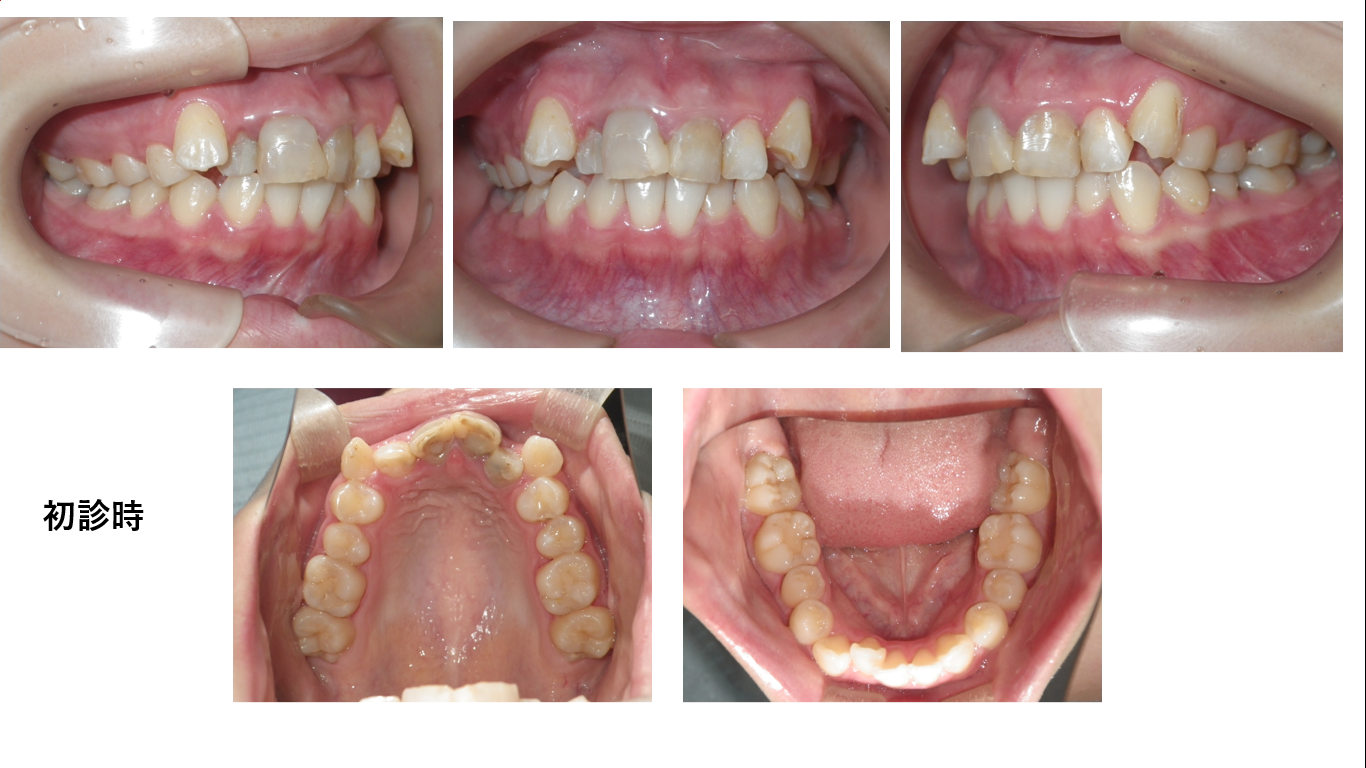 矯正症例107　AngleⅠ級叢生、下顎3本切歯症例、北秋田市、大館市、能代市、秋田市
