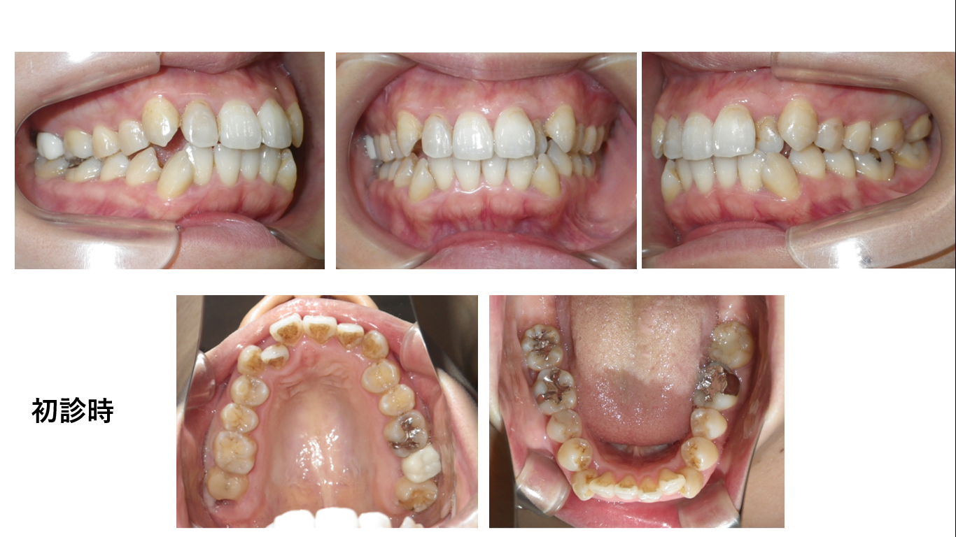矯正症例118 AngleⅠ級上下顎前突、ハーフリンガル、舌側矯正、裏側矯正、能代市、北秋田市、秋田市、大館市