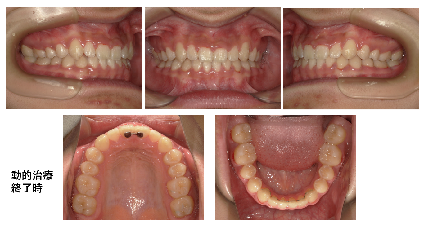 矯正症例104　AngleⅠ級、過蓋咬合、非抜歯矯正、能代市、北秋田市、秋田市、大館市