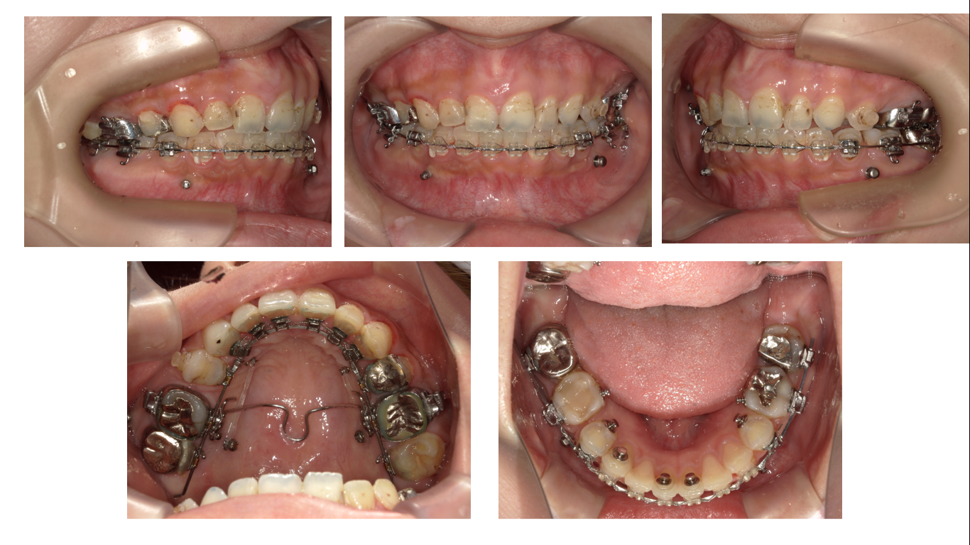 矯正症例112,AngleⅡ級1類、ハーフリンガル症例、舌側矯正、裏側矯正、能代市、北秋田市、秋田市、大館市