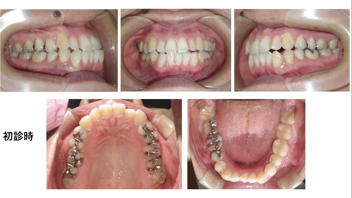矯正症例120 Skeletal classⅢ叢生、下顎3本切歯症例、ハーフリンガル、舌側矯正、裏側矯正、能代市、大館市、北秋田市、秋田市