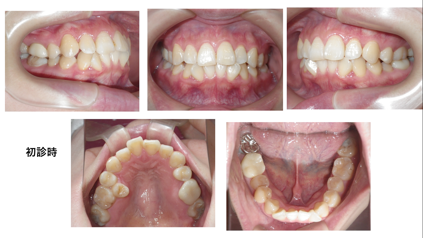 矯正症例116AngleⅡ級叢生、能代市、北秋田市、大館市、秋田市