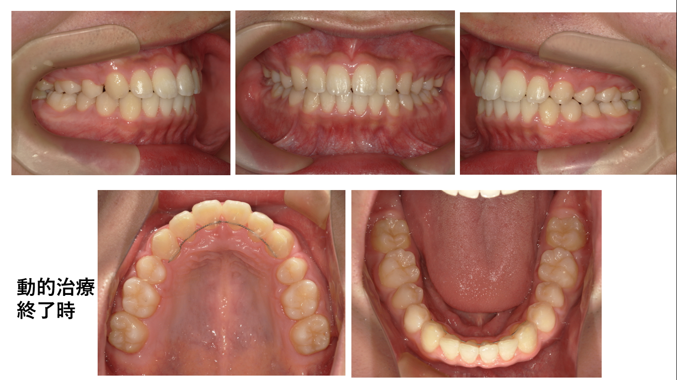 矯正症例122 Angle classⅡ 上顎前突、能代市、北秋田市、秋田市、大館市