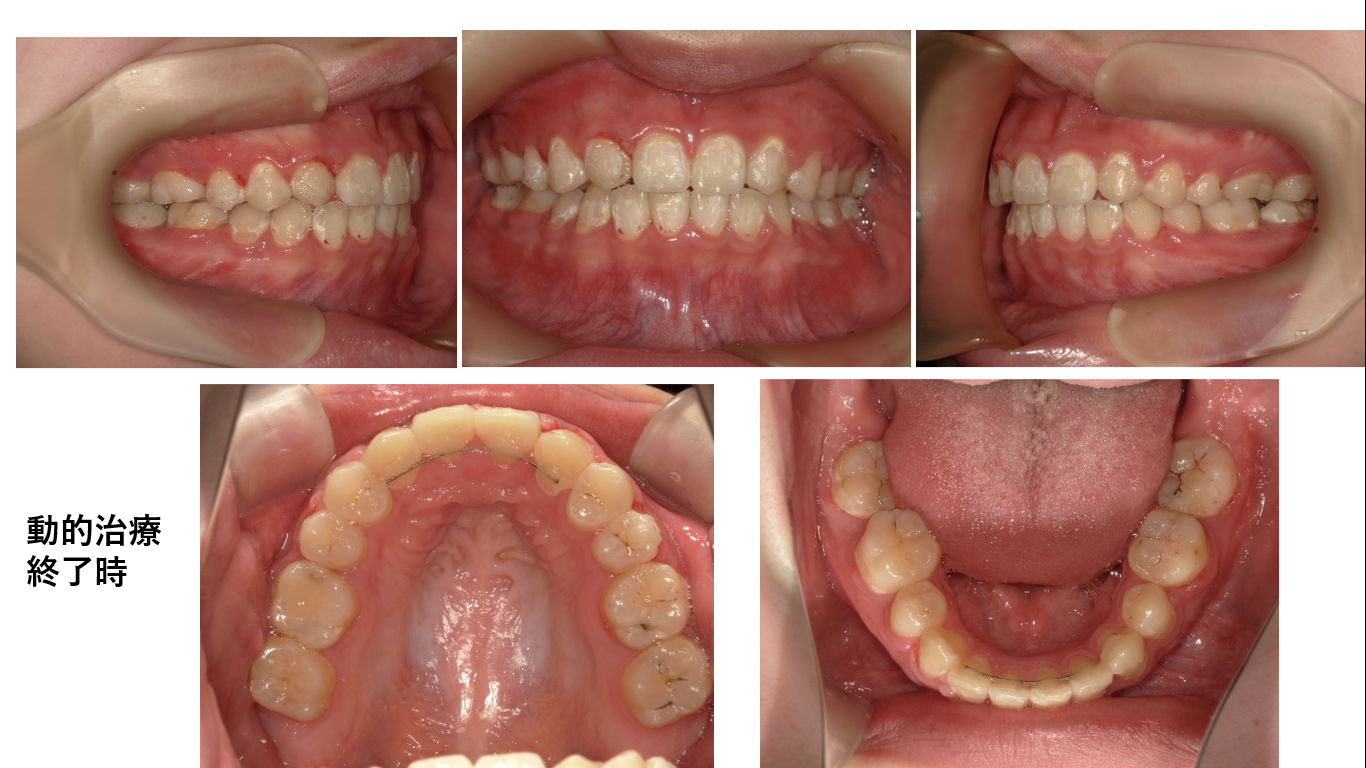 矯正症例115　AngleⅠ級叢生、上顎左右側2番抜歯症例、能代市、大館市、北秋田市、秋田市