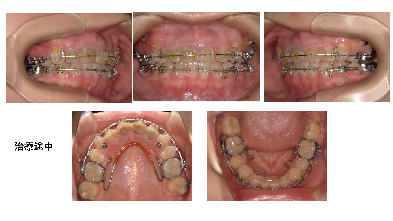矯正症例107　AngleⅠ級叢生、下顎3本切歯症例、北秋田市、大館市、能代市、秋田市