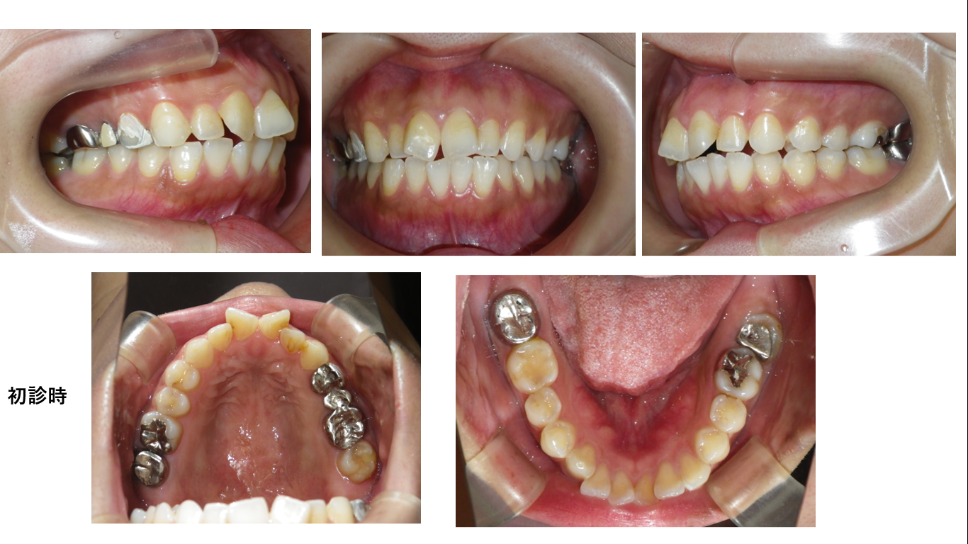 矯正症例112,AngleⅡ級1類、ハーフリンガル症例、舌側矯正、裏側矯正、能代市、北秋田市、秋田市、大館市