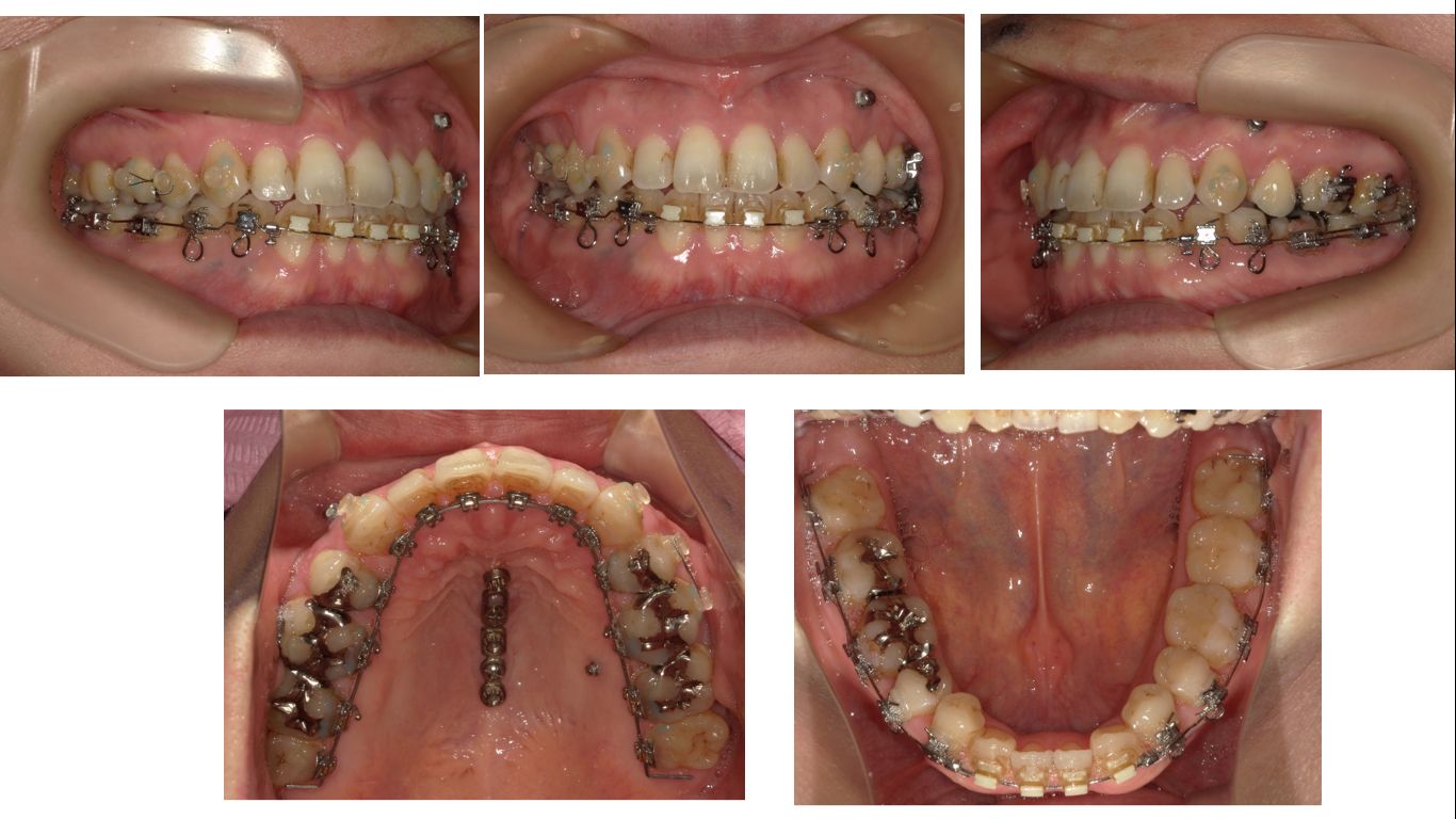 矯正症例120 Skeletal classⅢ叢生、下顎3本切歯症例、ハーフリンガル、舌側矯正、裏側矯正、能代市、大館市、北秋田市、秋田市