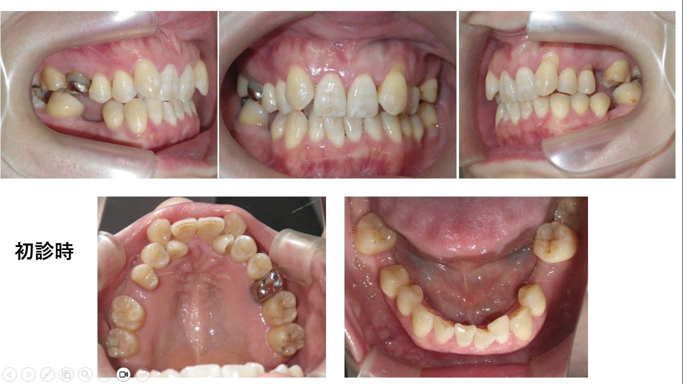 矯正症例108　AngleⅠ級叢生、能代市、北秋田市、大館市、秋田市