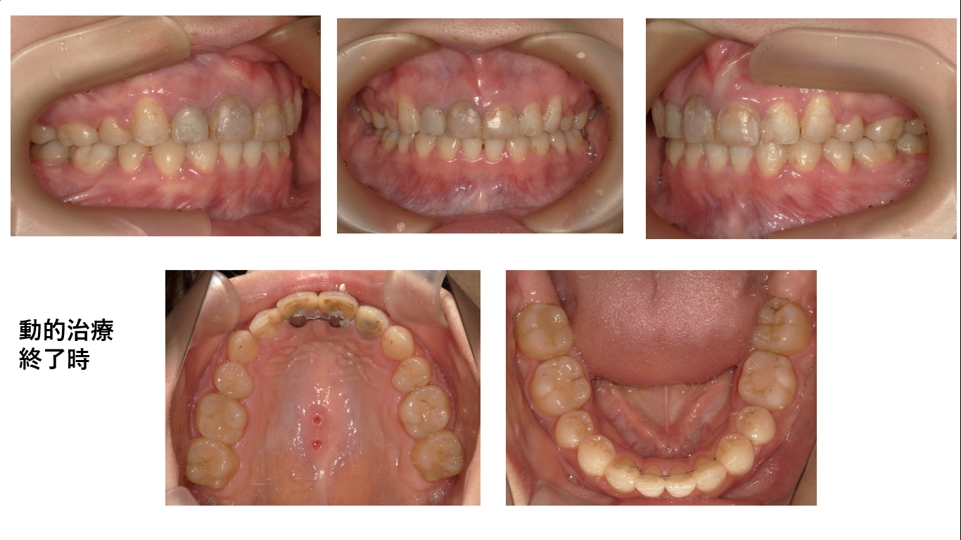 矯正症例107　AngleⅠ級叢生、下顎3本切歯症例、北秋田市、大館市、能代市、秋田市