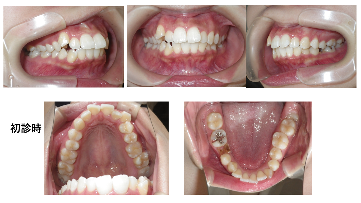 矯正症例113 AngleⅠ級叢生、能代市、北秋田市、大館市、秋田市