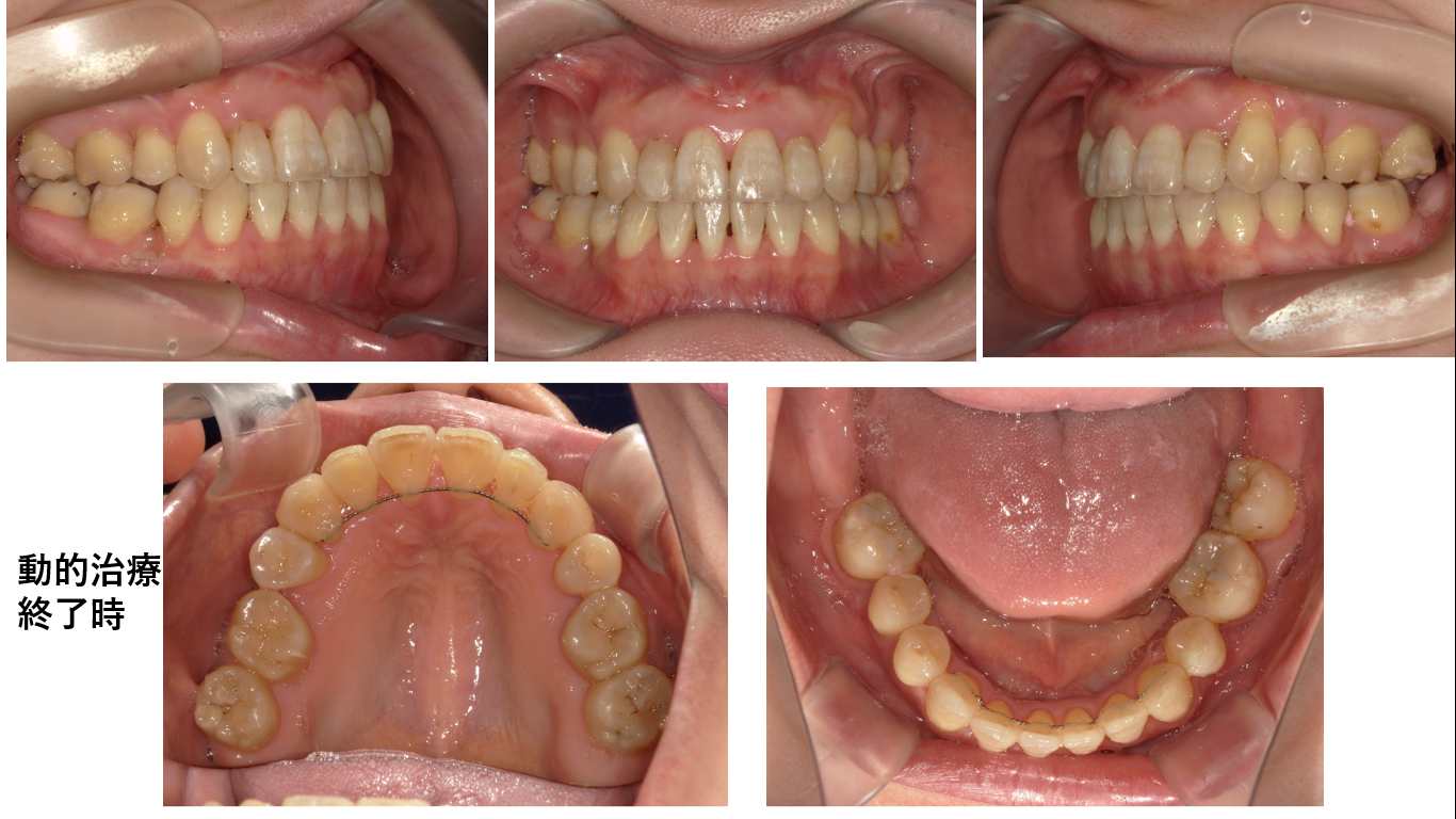 矯正症例108　AngleⅠ級叢生、能代市、北秋田市、大館市、秋田市
