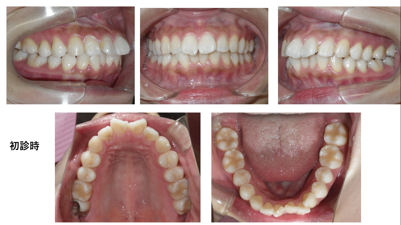 矯正症例109 AngleⅠ級上下顎前突、能代市、北秋田市、大館市、秋田市