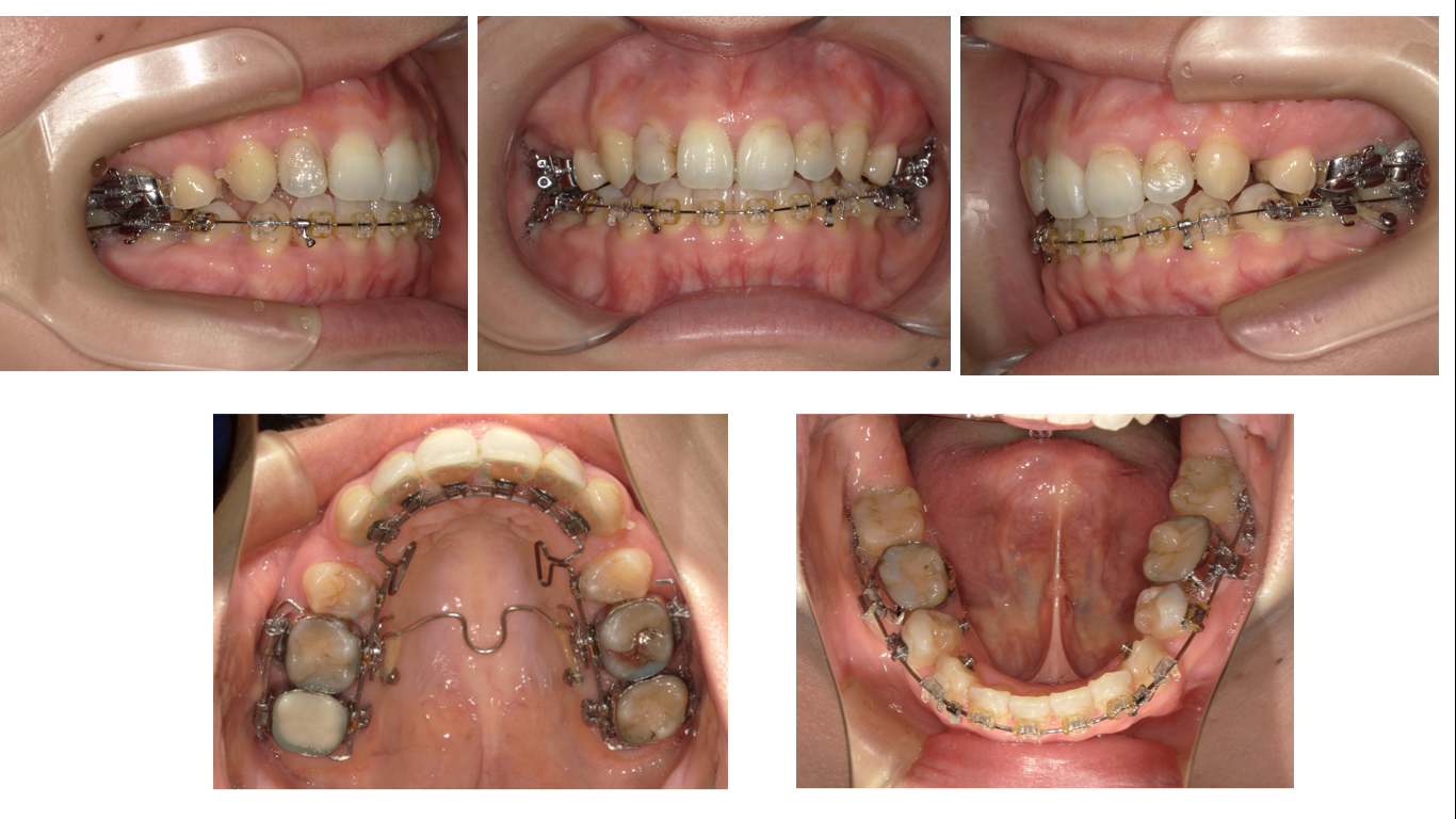 矯正症例118 AngleⅠ級上下顎前突、ハーフリンガル、舌側矯正、裏側矯正、能代市、北秋田市、秋田市、大館市
