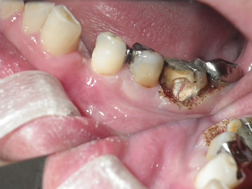 レーザーを用いた虫歯治療　レーザー　深い虫歯　能代市 北秋田市 大館市