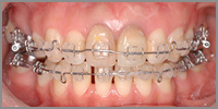 上下の前歯１２本が白または透明